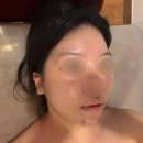 CU 화정요진타워점 | 여름철 여드름관리, 화정피부관리 이지미에스테틱 미생물관리후기