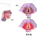 후두염 원인 열 기침 증상 급성후두염 초기증상 전염 치료 이미지