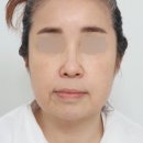 50대 안면거상술 비용 하나도 중요하지 않은 이유