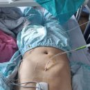 심장판막이랑 대동맥이 수술 이미지