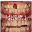 새미래치과기공소 | 임플란트 + 뼈이식. 앞니 흔들림? 뽑고 1달 기다리고 임플란트 + 뼈이식. 신사역 치과 후기/비용/과정.