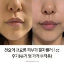 천호역 천호동 피부과 팔자필러 1cc 후기(붓기 멍 가격 부작용)