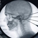 현대정형외과 | 편두통 신경 차단술 후기｜정형외과는 내과 시술과 달랐다 (2편_정형외과)