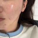 뮤즈21 | 의정부 피부관리 스킨뮤즈 : 트러블 케어 만족 후기