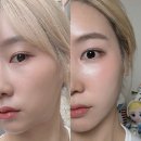 신논현약국 | 신논현피부과 옆볼패임 미희 콜라겐주사 효과