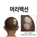 두부 백선