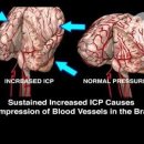 뇌압상승 이미지