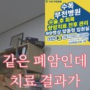 비소세포폐암 NGS유전자 패널 검사의 중요성 이미지