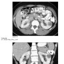 Kidney Benign renal tumors 이미지