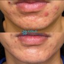 콜드플라즈마 이미지