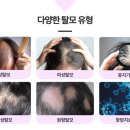 프리즘의원 | 은평구 탈모치료 후기 보기 전에 꼭 알아야 하는 현실 FAQ (통증·회복기간·효과)