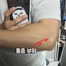 신경자 | 팔꿈치 통증 테니스엘보 MRI 비용 및 실비 보험 청구 후기