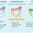 한국인의 5대암 - 대장암의 증상과 예후 이미지