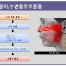 코골이/수면무호흡의 유형과 치료/광주성장클리닉 이미지