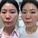 신사역 피부과 쥬베룩아이 1vial 시술후기 눈가주름 및 잔주름, 볼륨개선!