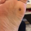 개발바닥 | 발바닥 사마귀 레이저 치료 수술 후기 (관리 방법, 주의할 점, 경과 / 사진O)