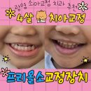 근기능장치 프리올소 이용한 4살 치아교정 리얼후기