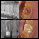 모래내치과의원 | 인천만수동치과 양심진료? 단계적으로 치료해야 과잉진료를 막을 수 있습니다 균열 치아 신경치료 후기