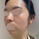 제이뉴피부과의원 | 제이필의원 홍대입구역피부과 초음파 재생관리 리뷰, 정보, 후기