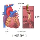 급성 심근경색증(Acute myocardial infarction) 순환기질환, 응급질환이란? 이미지