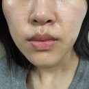 분당-365 | 얼굴살 없는 사람의 분당 피부과 올리디아 볼륨 365 콜라겐 주사 후기/통증/효과(+BBL 레이저)