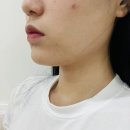 천안 성성동 이중턱 사각턱 피팅리프팅 후기+다이어트 병원 추천