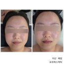 포유테라피 | 아산 배방 피부관리 포유에스테틱에서 R4U 에너지 테라피 받은 후기