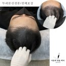마음에점을찍다두피SMP 이미지