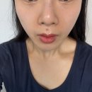 경기도성형외과 , 이쁜콧볼만들어주는 콧대주사 일주일후기 안양 코조각주사추천