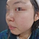전주 피부관리 홍조피부 딸기코 만성트러블을 가진 피부가 직접 받은 올가스킨 찐 후기
