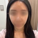 GOOD프라임호텔 | 턱선정리, 자연볼륨까지! 울쎄라피프라임+쥬베룩 시술 후 2개월 후기