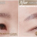 미로헤어라인 이미지