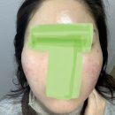 이노필 | 흉터 정복의 길 1 (브이빔, 이노필, 서브시전, 앰플시술)