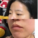 목동 아토피 한의원 치료 ; 한약치료 후기