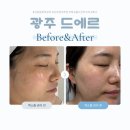 신창로 | 광주 신창동 피부관리 신부관리추천 색소고민 드에르 엑소좀 후기