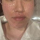 청담피부과 :: 수부지 피부 관리 리쥬란힐러 후기 손주사