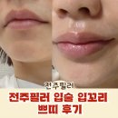 쁘띠멍 | 전주필러 입술 입꼬리 쁘띠 후기