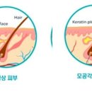 쏭쥬 | 그린 토마토 모공 앰플 레이저 시술 캐시 워크 알아보자