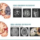 뇌혈관질환 이미지
