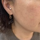 방화역 | 방화역 내과 피부과 겨울철 건조한 피부 리쥬란 2cc 플라몬 후기