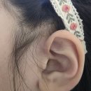 이루공수술후기 초4 성형외과 부분마취 비용& 꼬멘흉터 +회복중인 모습