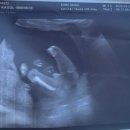[임신 12~18주]1,2차 통합기형아검사 다운증후군 고위험