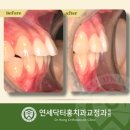 돌출입 해소를 위한 송도 연세닥터홍 치과 발치 재교정 사례