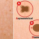 몸에 ‘이 모양’ 점 있으면 암의 신호 이미지