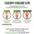 라온의원 | 출산후 산후검진 자궁경부 이형성증 CIN3진단받고 원추절제술 후기 (대전라온산부인과)
