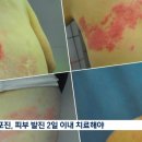 폭염 후유증 '대상포진' 급증..즉시 치료 필요해 이미지