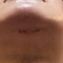 강남최선생 | 이중턱 근육묶기 + 이중턱 지방흡입 + 보조개 내돈내산 2주차 후기