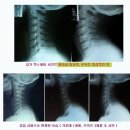 경추 1~7번 증상 이미지