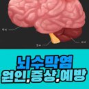 뇌수막염 원인 만성 뇌수막염 이미지