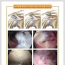 어깨통증의 또 하나의 원인! 어깨충돌증후군이란?? 이미지